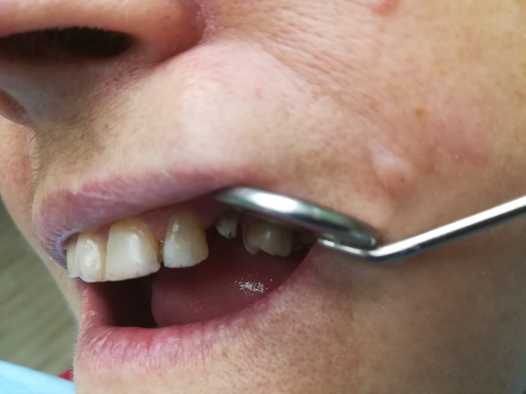 Metalokeramička krunica gornjeg očnjaka - PRE